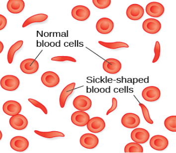 An illustration shows round and sickle-shaped blood cells.