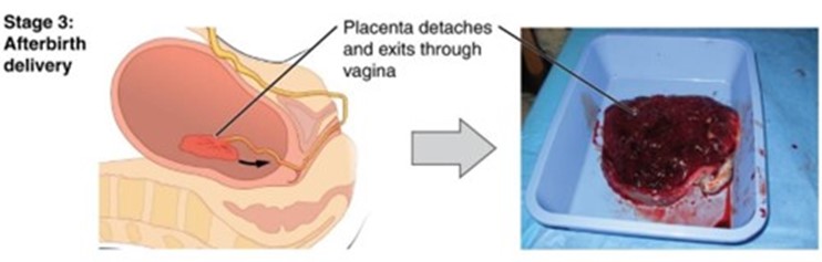 Illustration of the placenta detaching and expelling after birth. Photograph of expelled placenta.