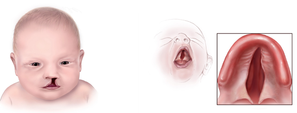 Illustration (left), of child with cleft lip and (right) illustration of child with cleft palate.
