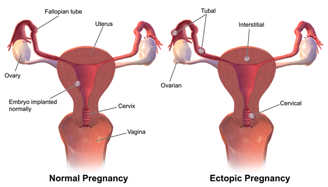 Illustration of proper implantation of the zygote into the uterine wall alongside illustration of 4 types of possible ectopic pregnancies.