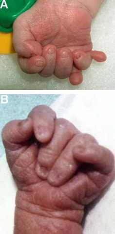Two photographs which show overlapping fingers, which can result from Edwards Syndrome.