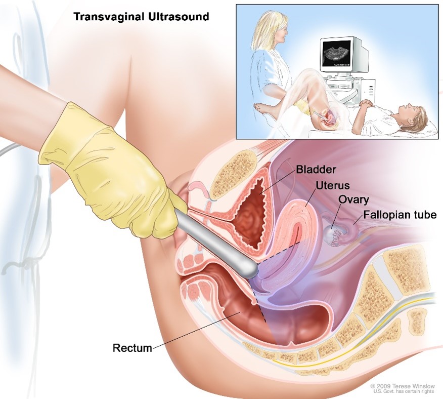 Illustration of transvaginal ultrasound