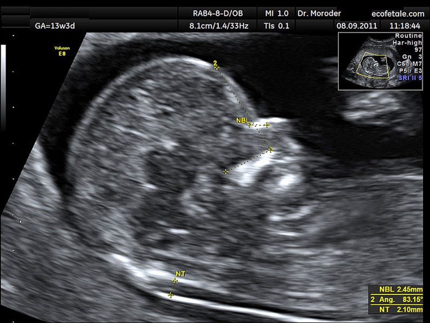 Ultrasound of measurements taken during fetal nuchal translucency test taken at 13 weeks gestational age.
