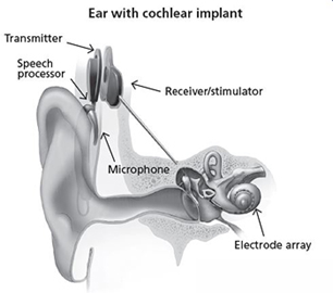 Illustration of how cochlear implant operates