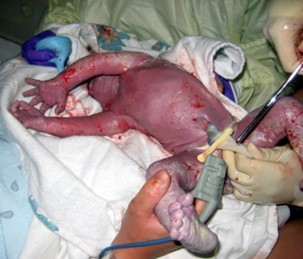 Clamping and cutting of newborn's umbilical cord