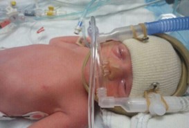 A premature baby on a "Continuous Positive Airway Pressure" (CPAP) in the Neonatal Intensive Care Unit (NICU)