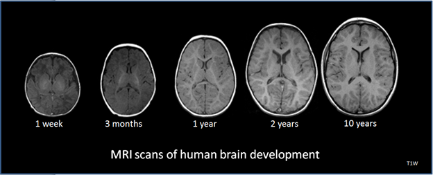 MRI scans showing the development of the human brain