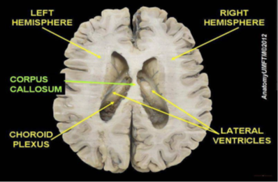 Image of the brain showing the corpus callosum area shaded in green