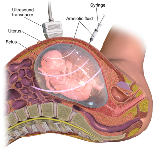 Illustration of Amniocentesis