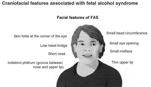 Illustration of adolescent with Fetal Alcohol Syndrome.