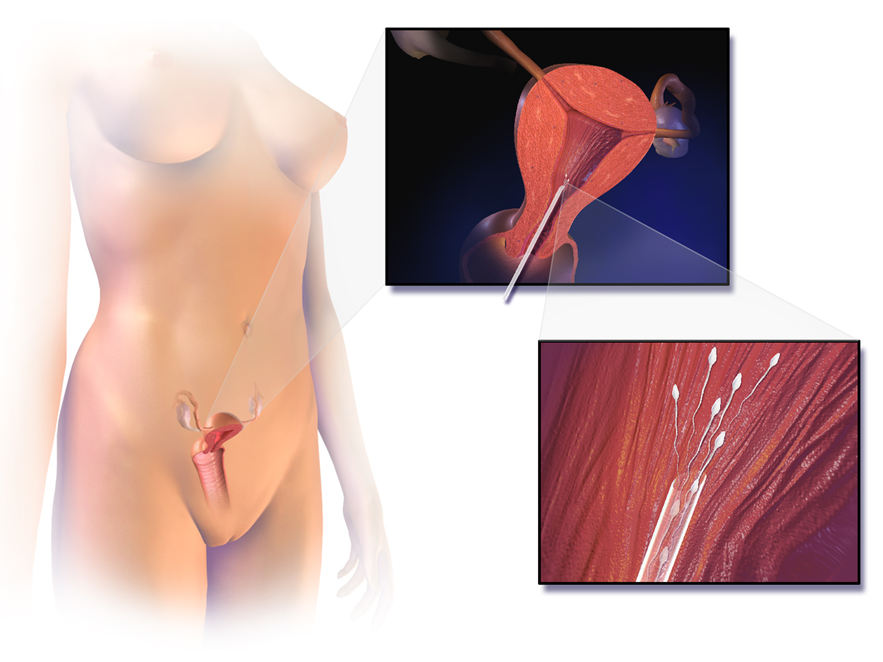 Illustration of artificial insemination showing ovaries located in body, and release of sperm into the uterus.