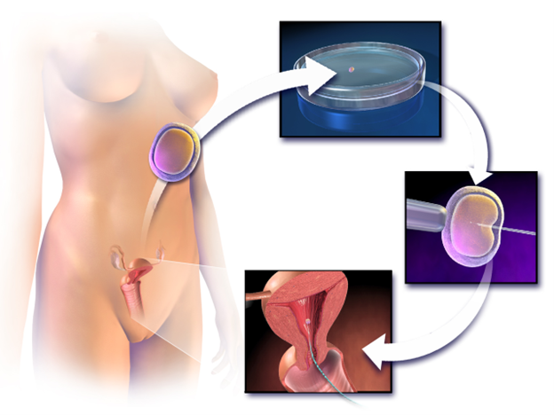 Illustration of in vitro fertilization beginning with extraction of the egg from the ovary. Next, the egg is placed in a petri dish and injected with sperm. Once the egg is fertilized it is placed into the uterus.
