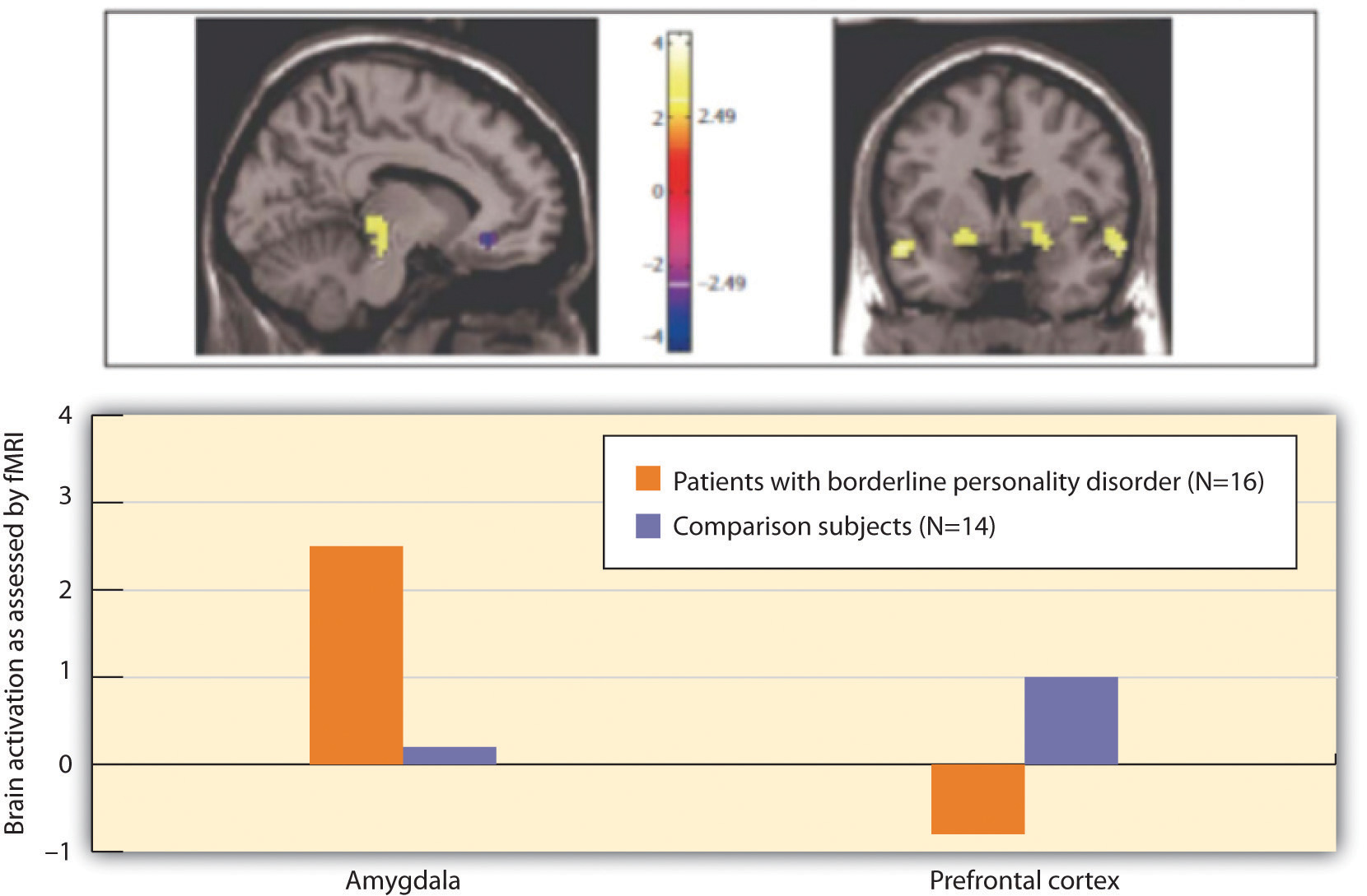 Individuals with BPD showed less cognitive and greater emotional brain activity in response to negative emotional words.