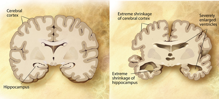 A healthy brain versus a brain with advanced Alzheimer's disease (shrinking of hippocampus and cerebral cortex)