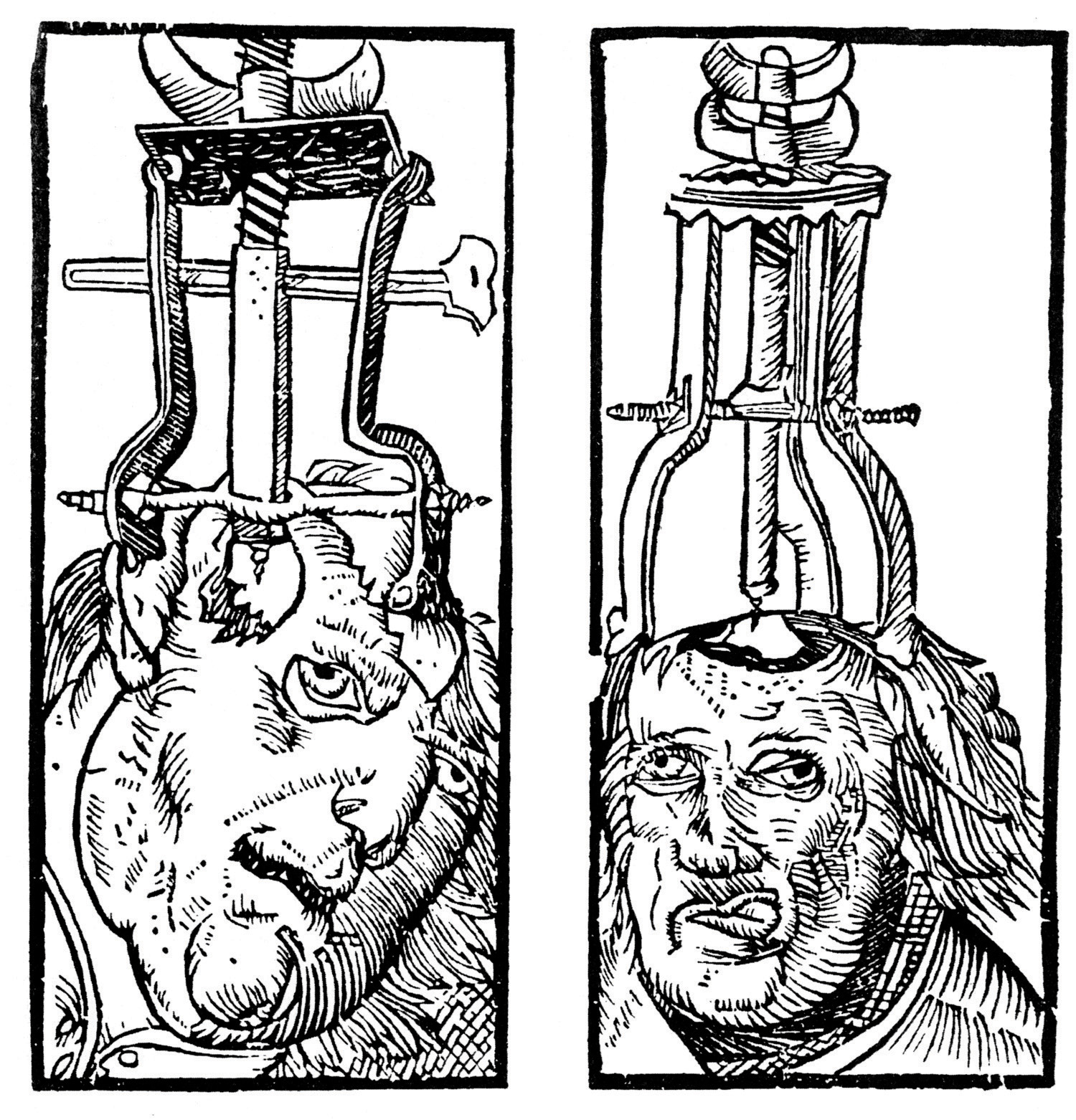 Trepanation (drilling holes in the skull) has been used since prehistoric times in attempts to cure epilepsy, schizophrenia, and other psychological disorders.