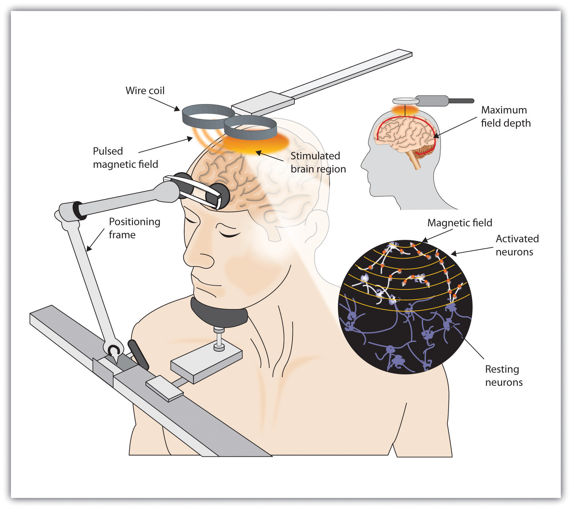 Transcranial Magnetic Stimulation (TMS)