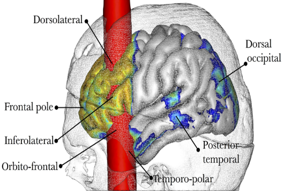 MRI reconstruction shows pole going through frontal areas of the brain including OFC,inferolateral and DLPFC