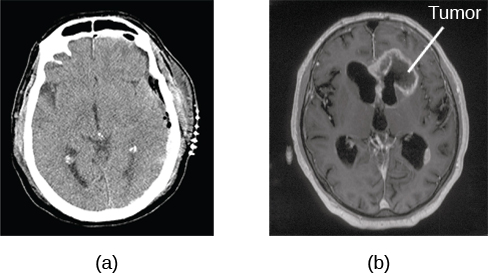 Two CT scans of brain. Image (b) on the right has dark areas one is labeled as a tumor