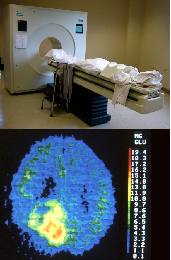 A) Photo of a PET scanner - has circular hole for the body to be imaged in and a bed in front (b) a PET scan of the brain - mostly blue, with a yellow and red area indicating the presence of a tumor.