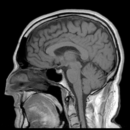 MRI scan - showing sagittal section of brain in great detail