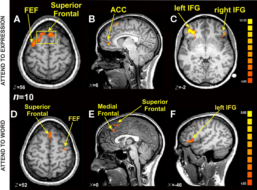 fMRI image shows activity in superior frontal, anterior cingulate cortex. inferior frontal and medial frontal areas