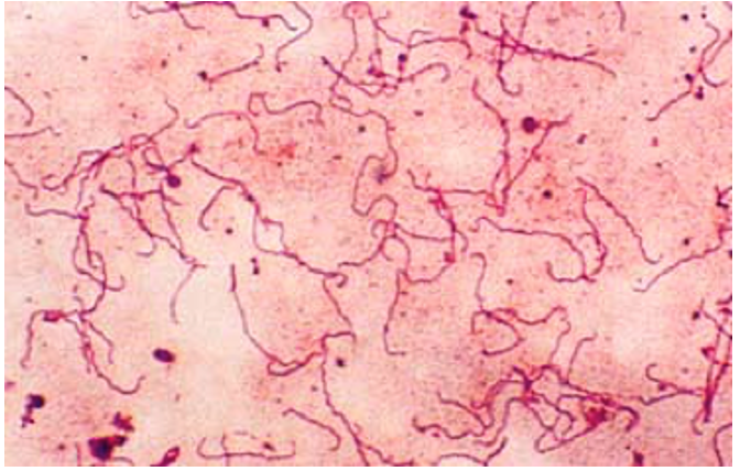 Figure 5. Treponema pallidum under the light microscope (Gram -) 1000x. Author: Dmitry Brogun Treponema pallidum: T. pallidum is Gram-negative and spirillum-shaped. Red spiral colored cells.