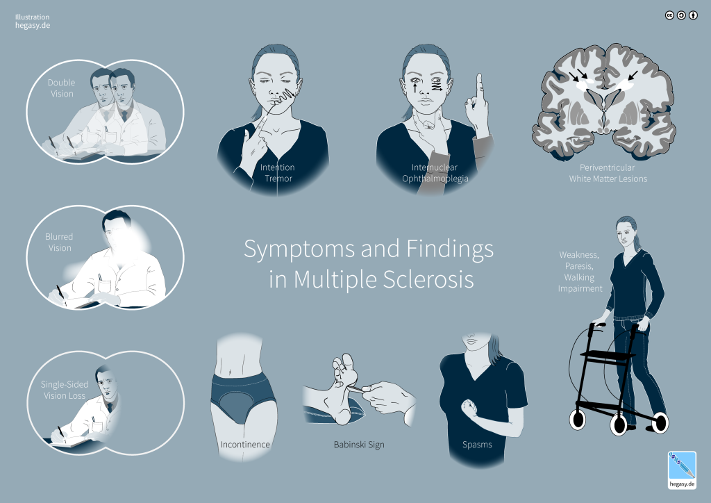 12.8: Multiple Sclerosis – Brain and Behavior