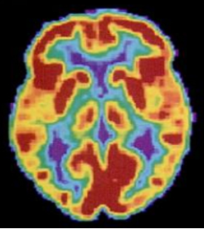 A brain scan shows different parts of the brain in different colors.