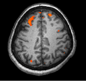 A brain scan shows brain tissue in gray with some small areas highlighted red.